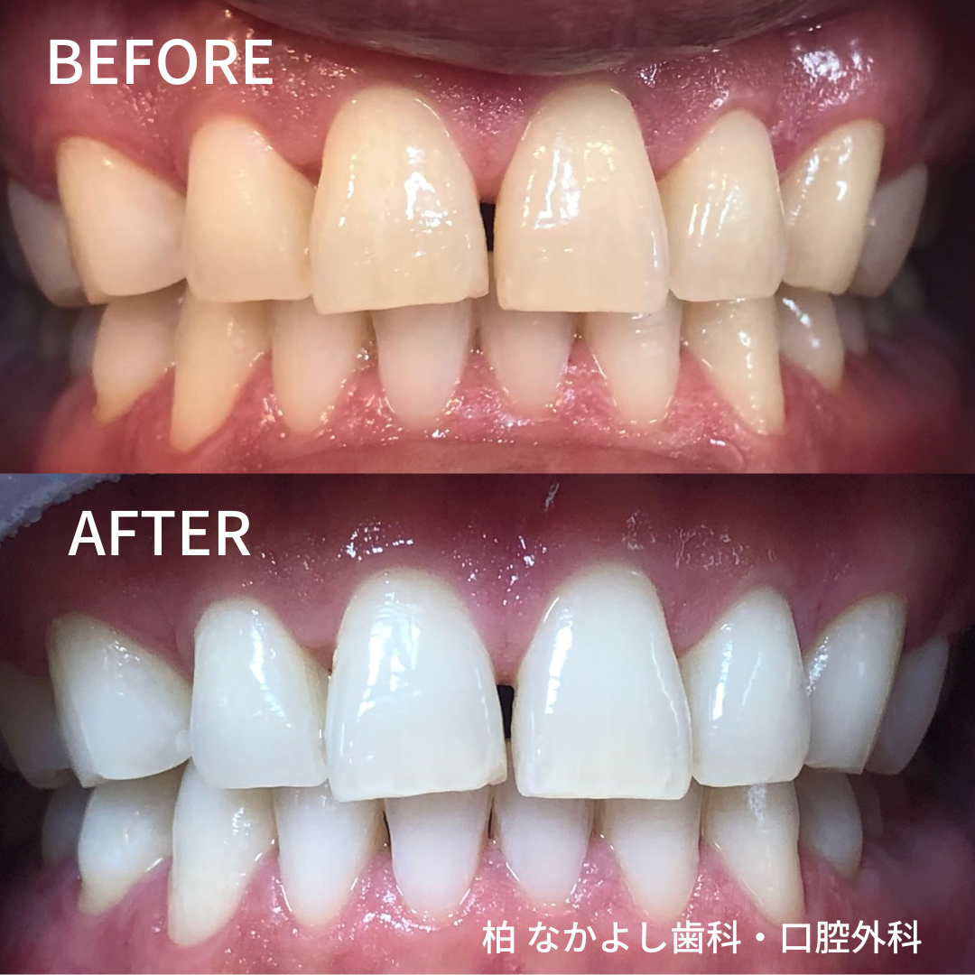 ホワイトニング　症例写真